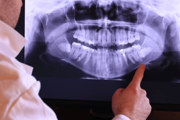 Best Emergency Tooth Extraction in Folsom, CA
